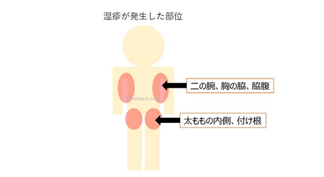 赤い斑点・湿疹の箇所